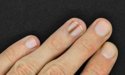 Diagnosis and early detection of nail melanoma
