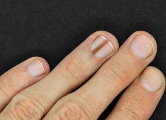 Diagnosis and early detection of nail melanoma